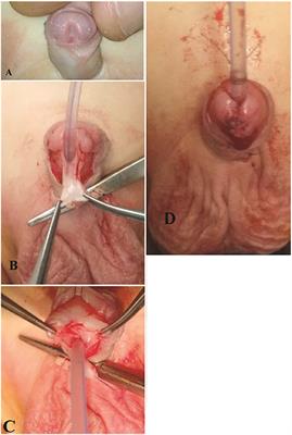 Hybrid Mathieu Urethroplasty vs. Tubularized Incised Plate Urethroplasty for the Management of Distal Penile Hypospadias With a Small Glans